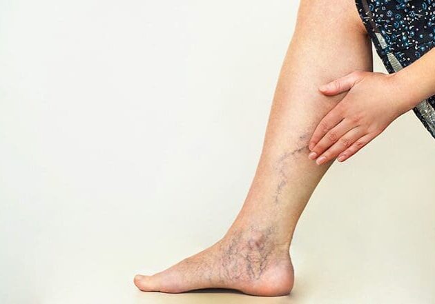 A person with varicose veins on their legs.